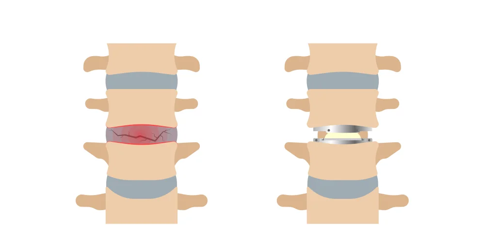 Orthopedic Implants